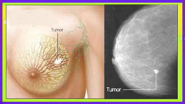 ব্রেস্ট বা স্তন টিউমারের হোমিওপ্যাথিক চিকিৎসা
