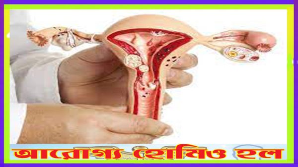 অতিরিক্ত রক্তস্রাব বা মেনোরেজিয়ায় হোমিওপ্যাথি চিকিৎসা