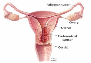 অনিয়মিত ঋতুস্রাবের কারণ ও করণীয় 