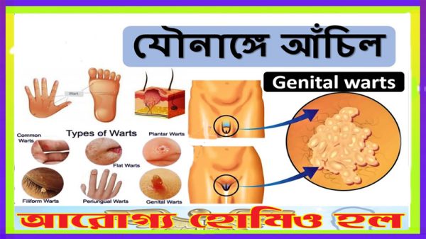 যৌনাঙ্গের আঁচিল এর হোমিওপ্যাথি ঔষধ