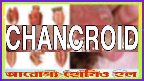 জেনিটাল চ্যানক্রোয়েড হোমিওপ্যাথি ঔষধ