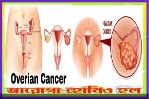 ডিম্বাশয় ক্যানসার