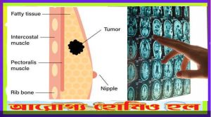 পুরুষদের স্তন ক্যান্সার হলে মহা বিপদ