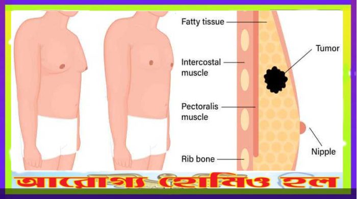 পুরুষদের স্তন ক্যান্সার হলে মহা বিপদ