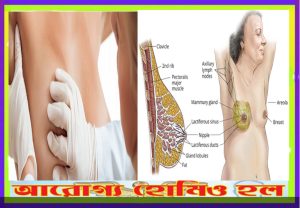 স্তন ক্যানসার (Breast Cancer)